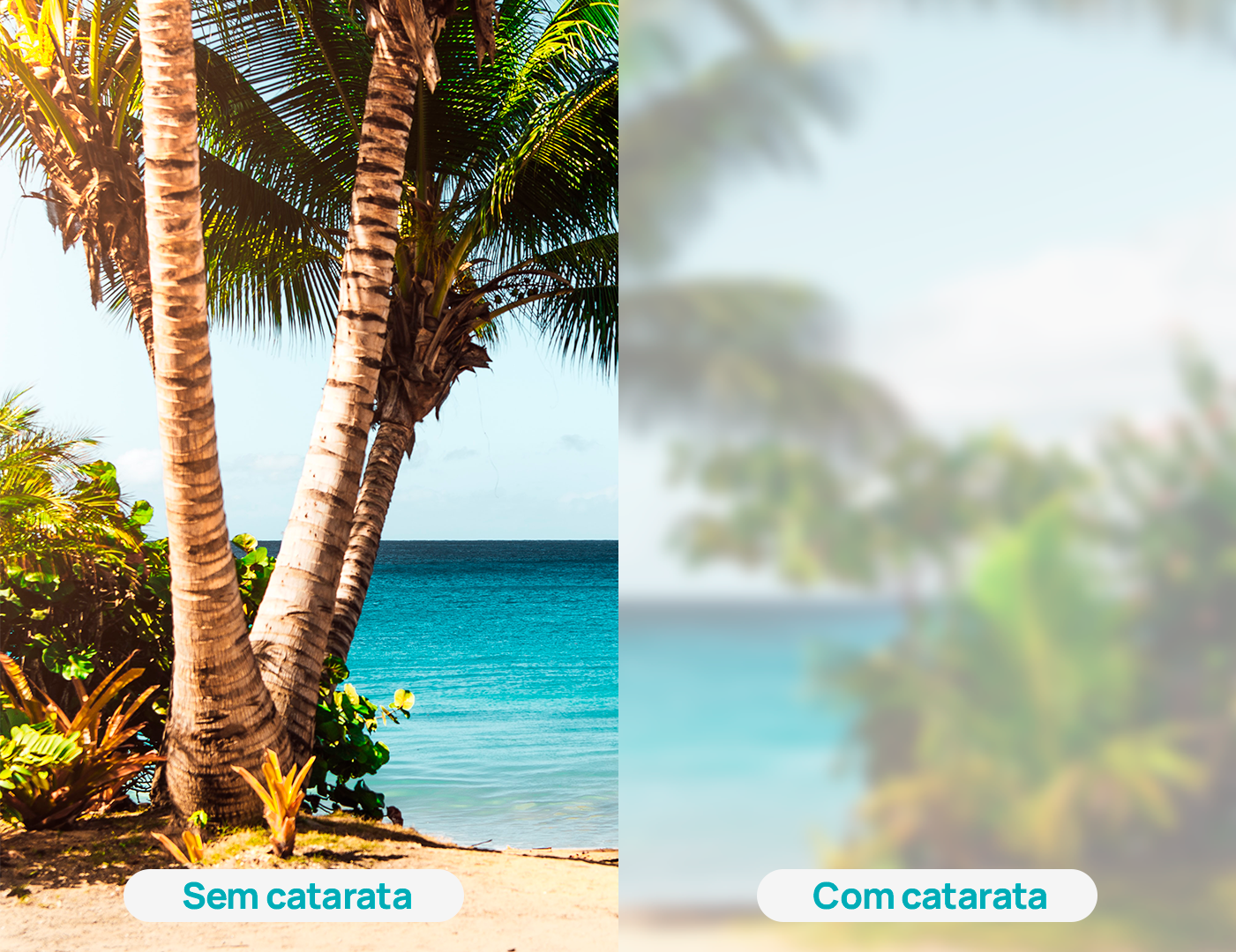 Cirurgia de Catarata com Lentes de Alta Tecnologia